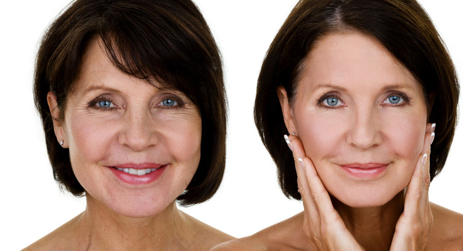 Anti-wrinkle injections treatment