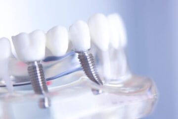 dental implant price