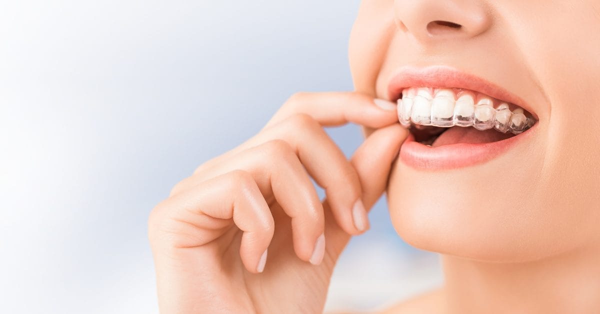 Invisalign
