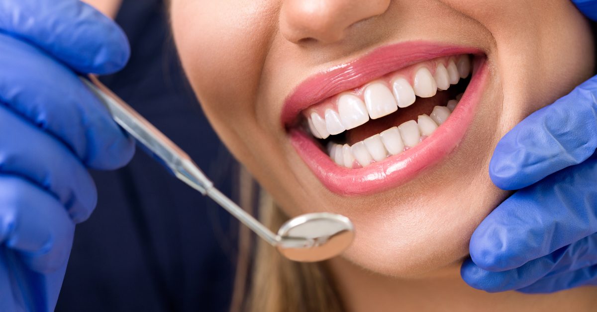 whiten composite bonding