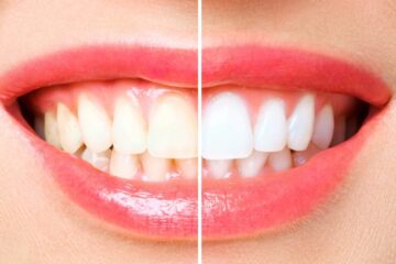 professional teeth whitening