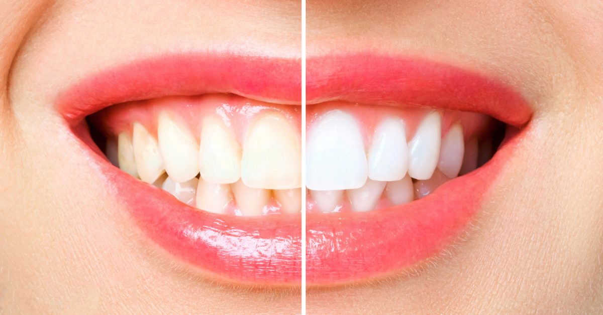 professional teeth whitening